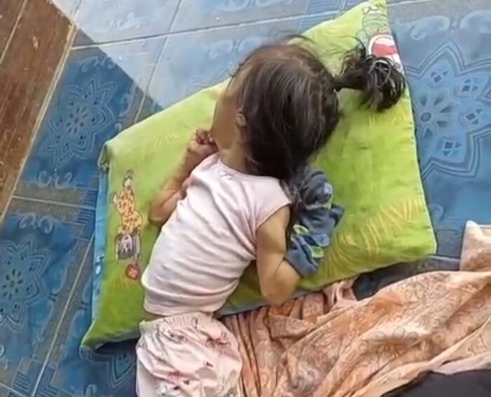 Anak 8 Tahun di Sukabumi Terbaring Sakit